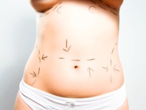 tummy tuck cost