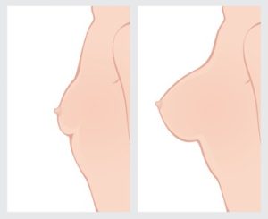 Breast Implants - Before and After Image Gallery, Plastic Surgery