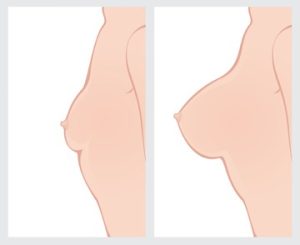 Atlanta Breast Augmentation Before After Photos Roswell Plastic