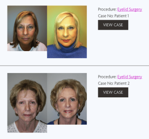 Blepharoplasty | Eyelid Surgery Before After Photos | Atlanta GA