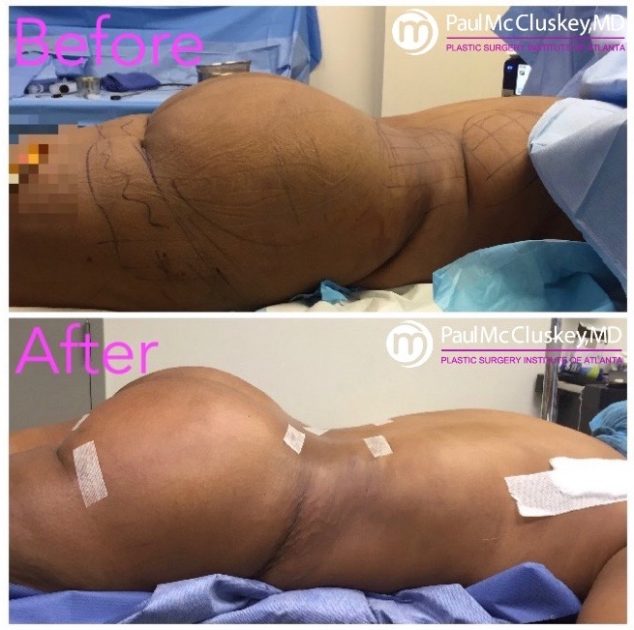 Buttocks surgery: buttock lift, body lift, buttock implants and