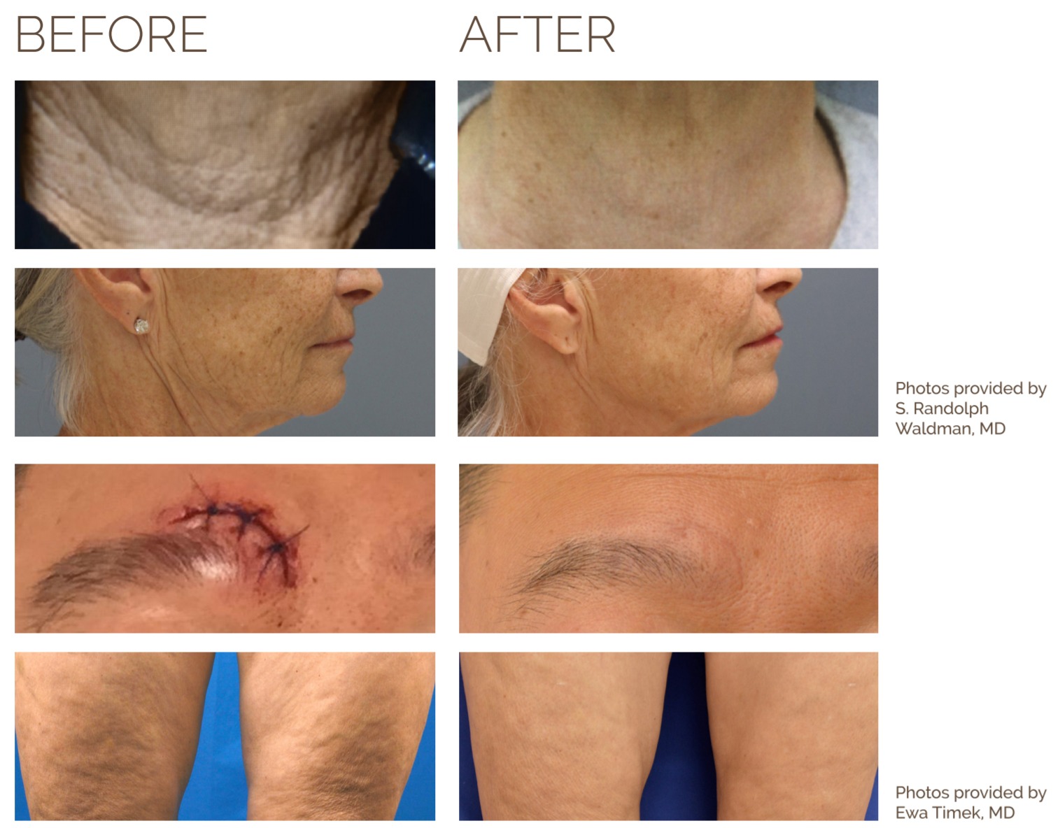 Radiofrequency Microneedling: Before and After Photos