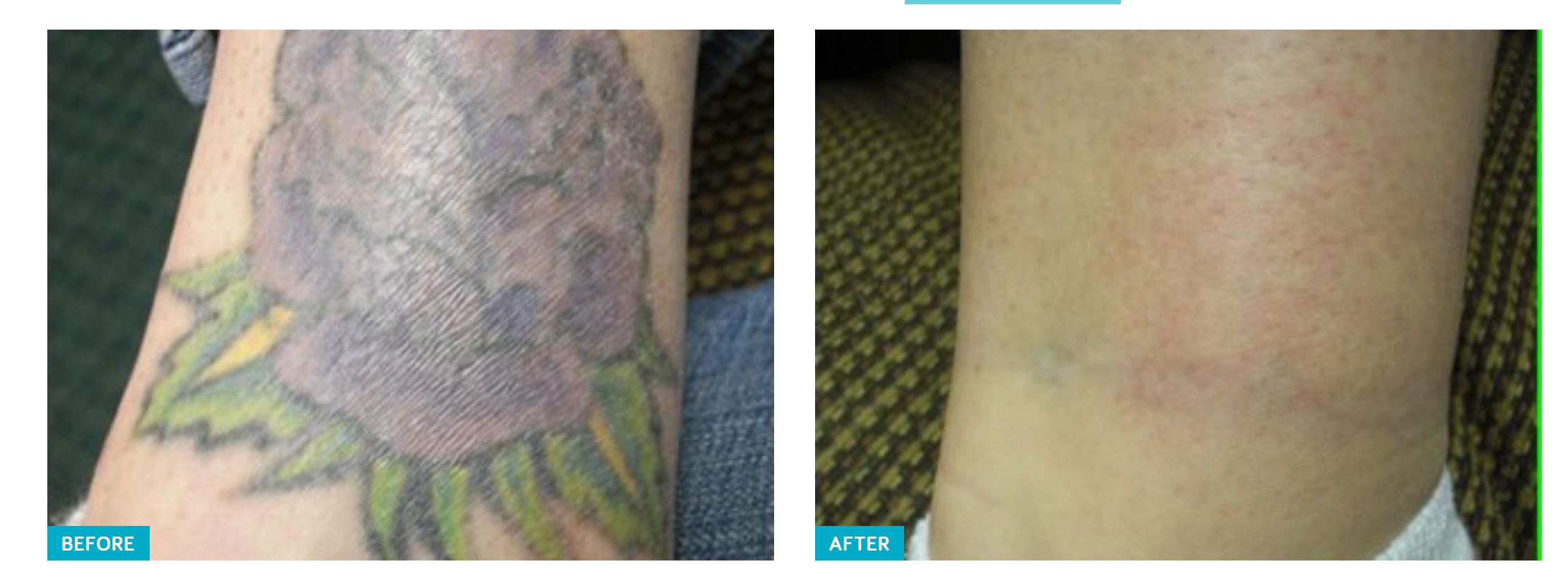 Tattoo Removal — Nourished MedSpa