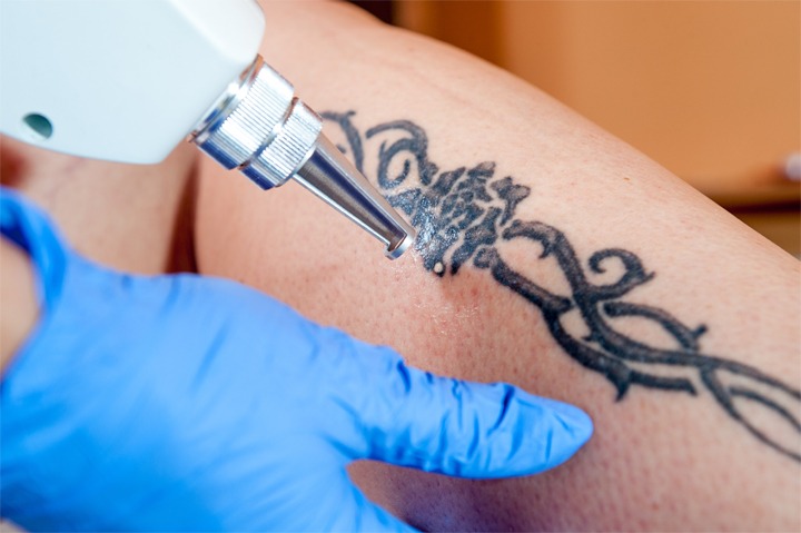 Does Laser Tattoo Removal Work on Dark Skin  Atlanta Georgia Med Spa