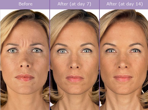 Botox to Reduce Wrinkles Marietta Atlanta Roswell Sandy