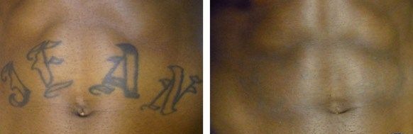 Laser Tattoo Removal  Pink Mink Nyc  Williston Park