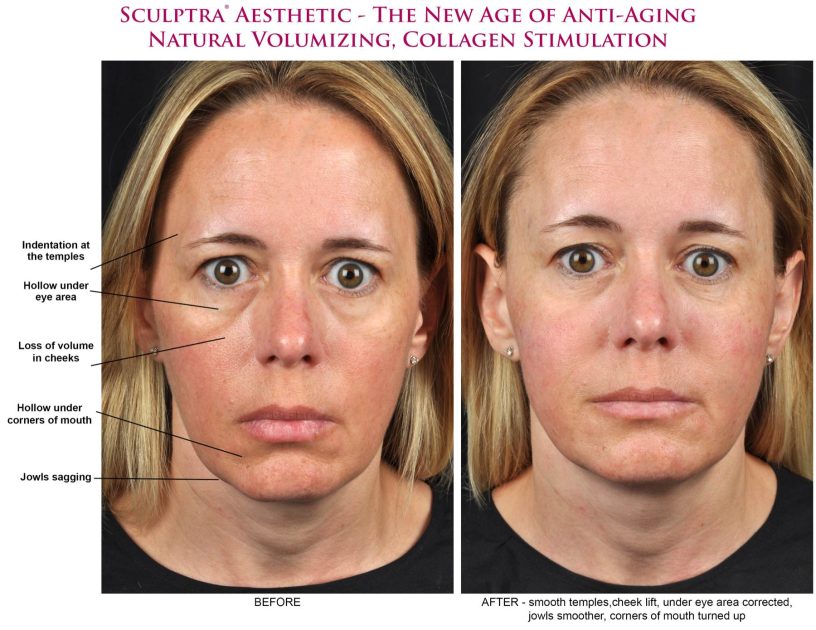 Sculptra Aesthetic Before After Photos Marietta Atlanta