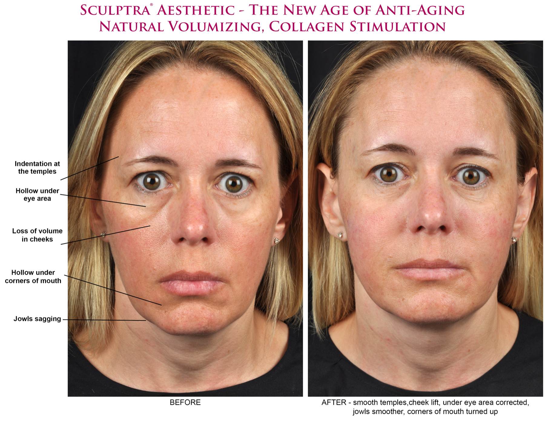 Sculptra Aesthetic Before After Photos Marietta, Atlanta