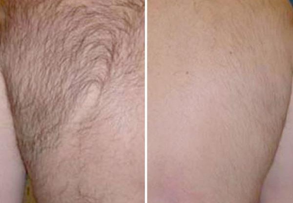 Laser Hair Removal For Back Hair Marietta Atlanta Roswell