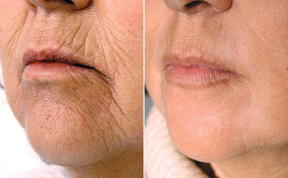 Erbium Laser Skin Resurfacing Get Rid Of Lines Wrinkles Marietta